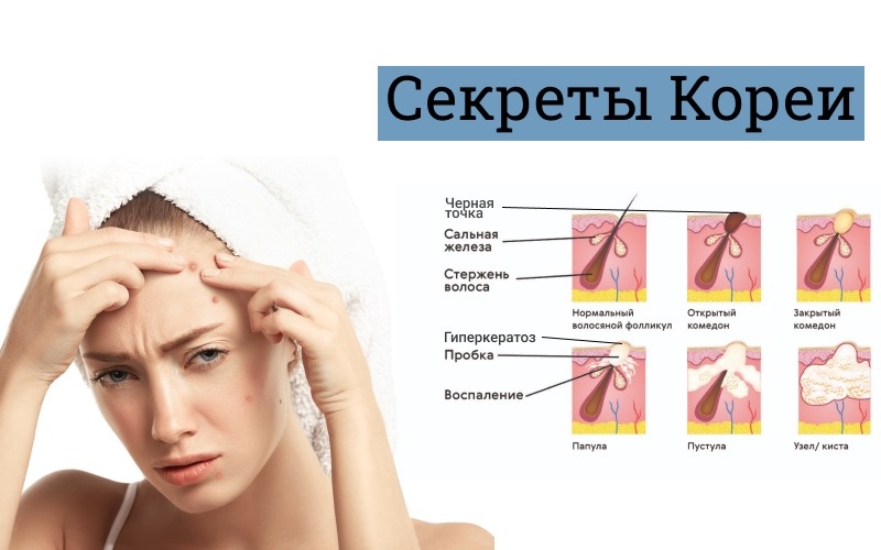 Как бороться с проблемной кожей? Или зачем коже кислоты.