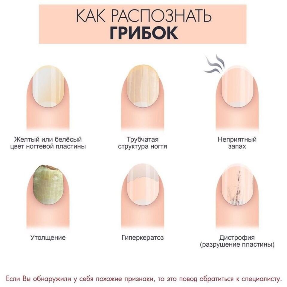 Изменение цвета ногтей: расшифровываем симптомы и ставим диагноз