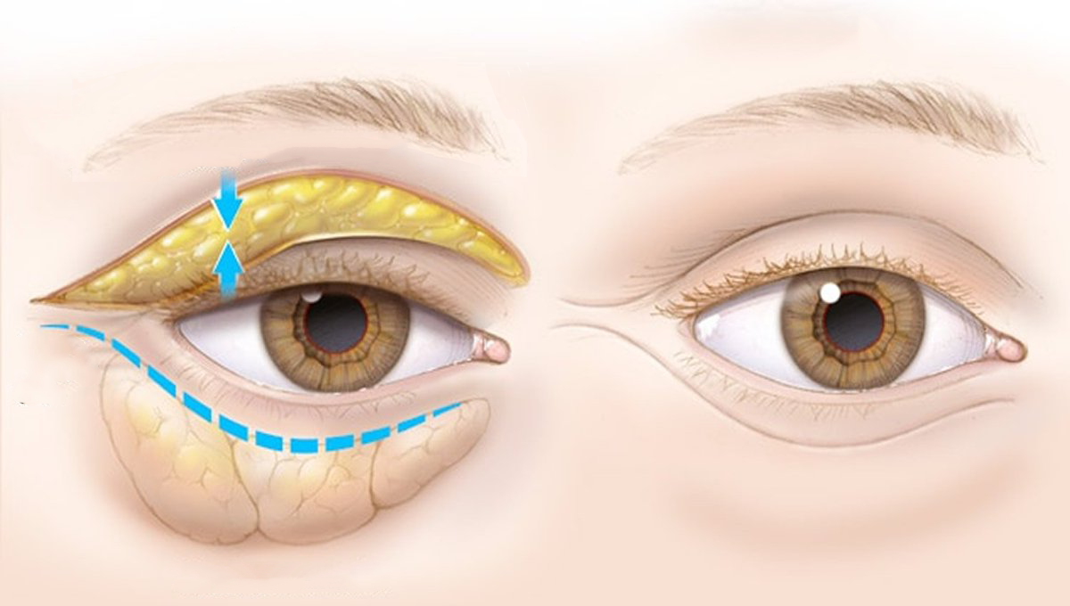 Мешки на веке глаза. Блефаропластика грыжи верхнего века. Пластика верхних век верхняя блефаропластика 1 схема. Грыжа Нижнего века схема. Жировые грыжи верхних век.