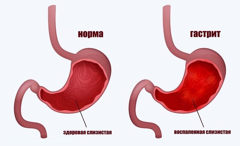 Хронический гастрит это. Острый и хронический гастрит. Нормальный желудок и гастрит. Здоровый желудок и гастрит.