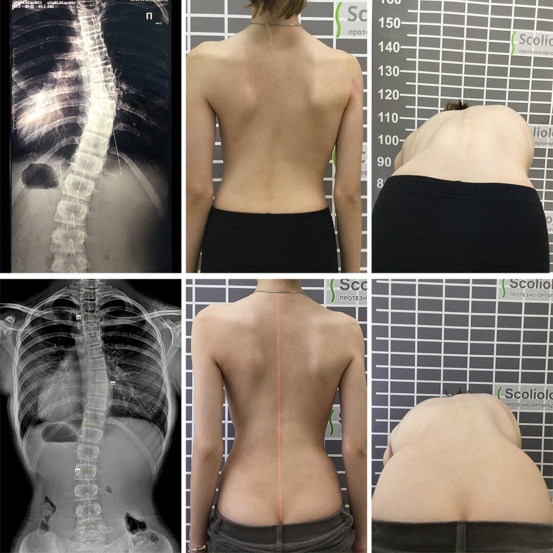 Сколиоз 2 степени. Сколиоз кифоз 3 степени. Сколиоз позвоночника 17 градусов. Сколиоз позвоночника 1ст. S образный кифосколиоз грудного отдела позвоночника.