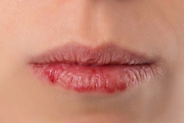 Трещины на губах и диабет.