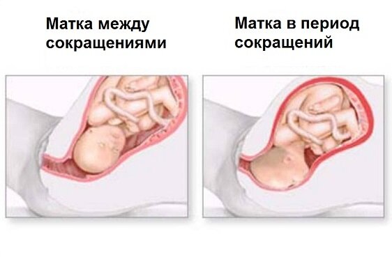 Классификация эндометриоза