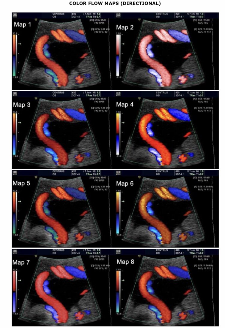 Фото с сайта FMF.org , на фотографии изображены сосуды плаценты.