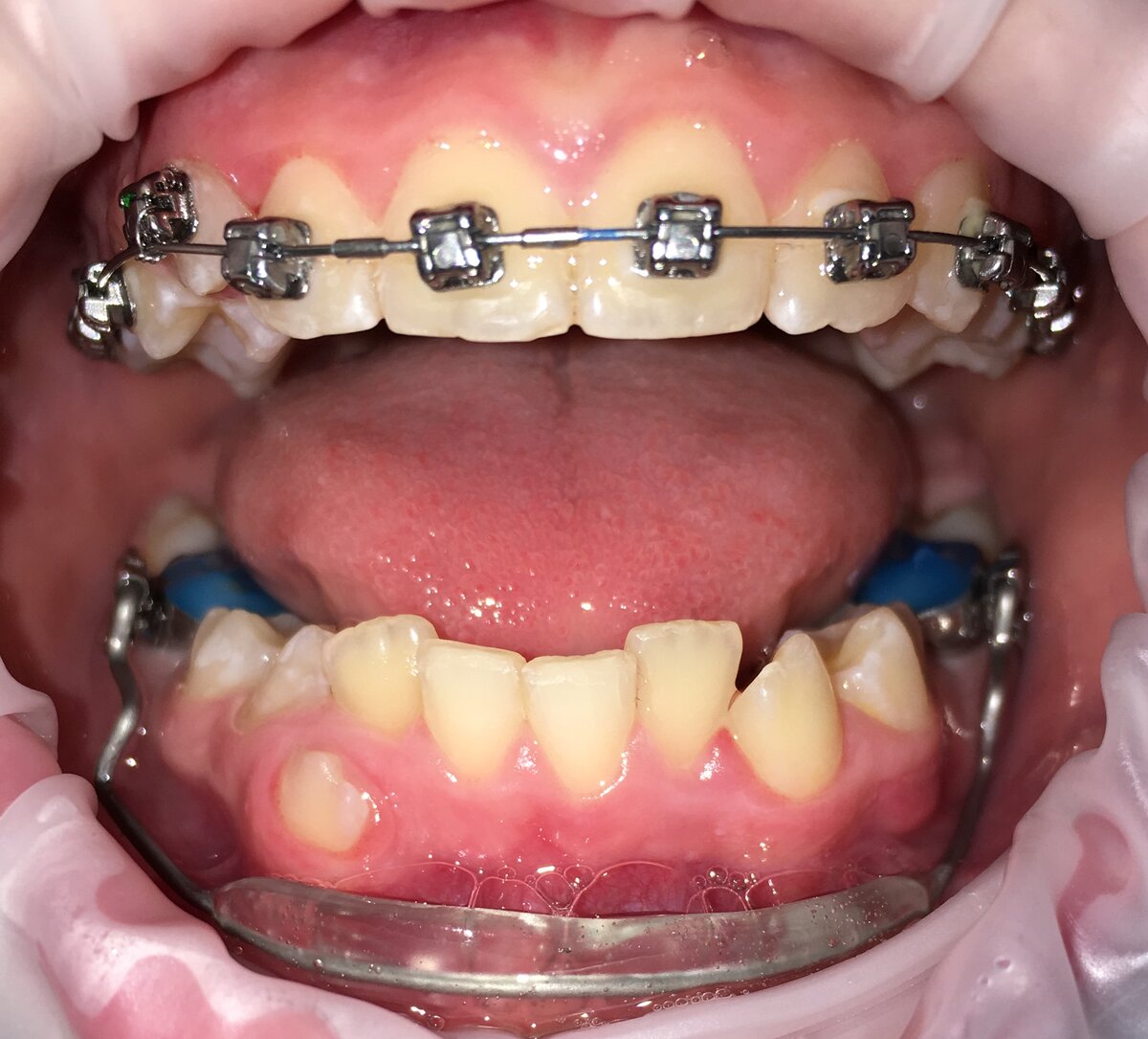 Проще всего ортодонта узнать по аппаратуре во рту его пациентов.