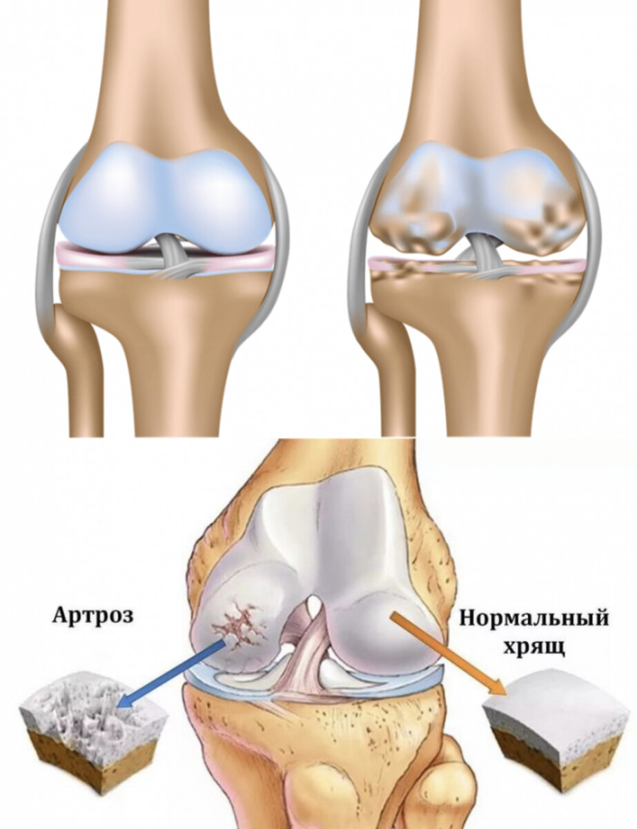 Деформирующий остеоартроз