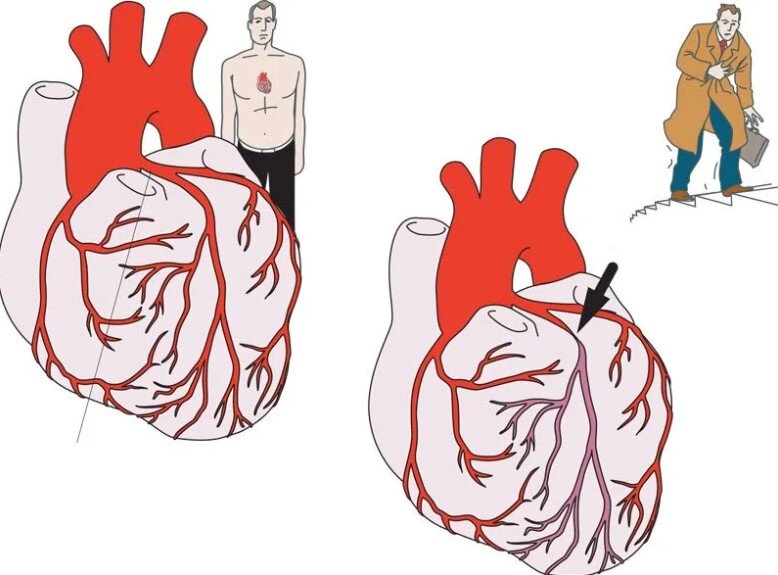 Что такое стенокардия?