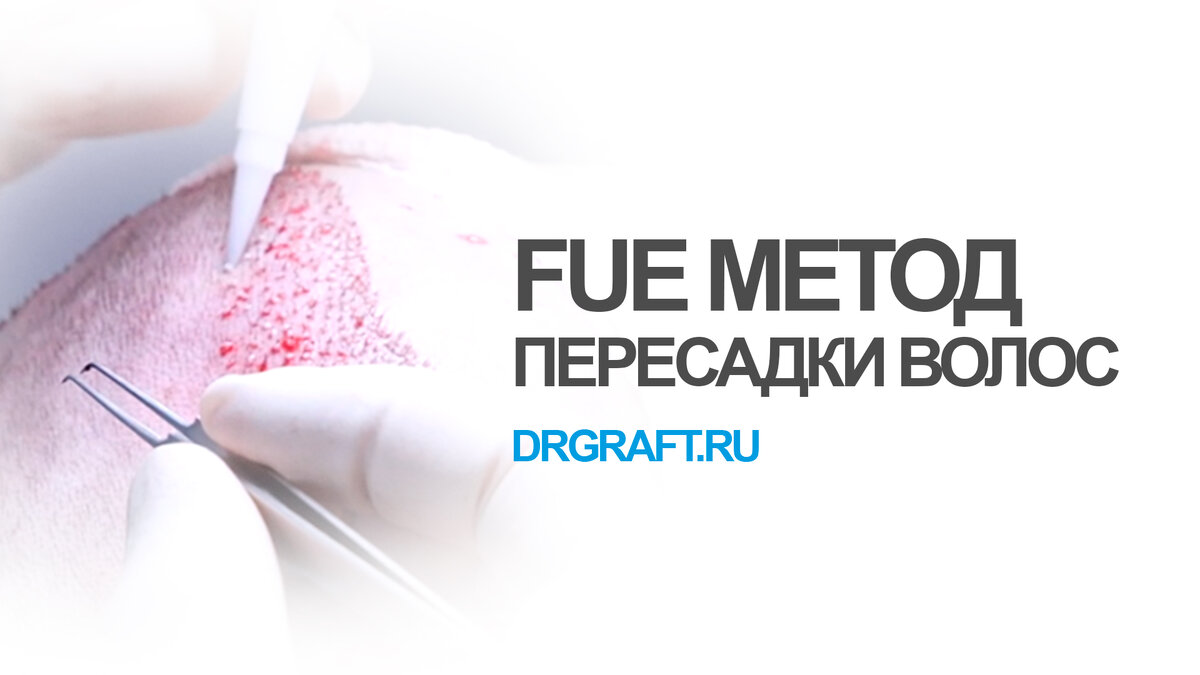 FUE метод пересадки волос (Follicular Unit Extraction)