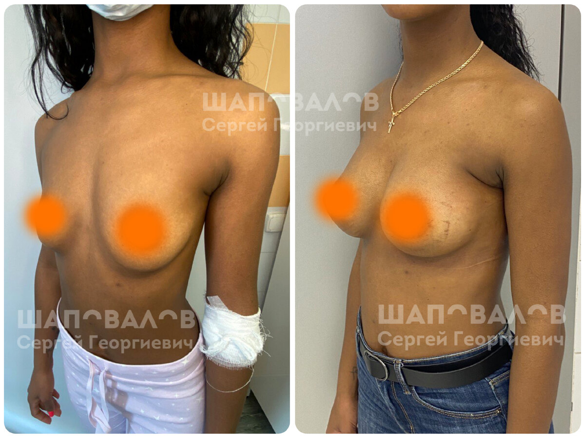 операция на груди у женщин фото 21