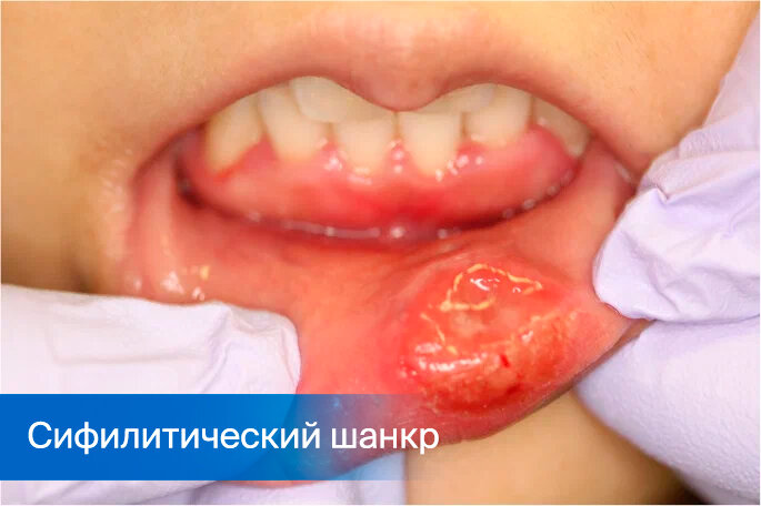 Сифилис полости рта