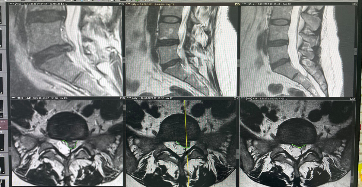 Результат безоперативного лечения грыжи диска L5-S1. При лечении применялась низкотнтенсивная лазеротерапия, иглоукалывание, магнитотерапия и ЛФК