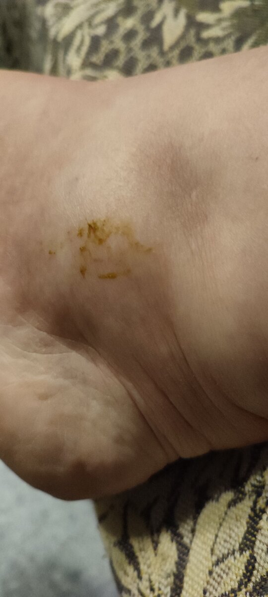 И это не йод. Это то, что проявилось от крема. Ничего особенного, царапинки какие-то. 