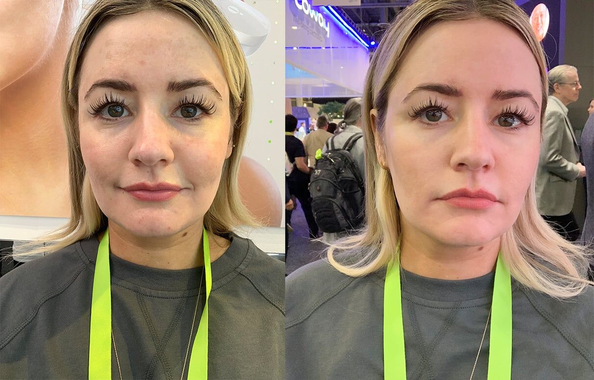 Фотографии перед использованием Opte wand и после. Фото: kirbiejohnson / instagram.com