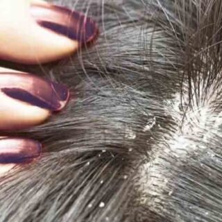 Себорея кожи волосистой части головы - лечение сухой и жирной себореи, перхоти в ОН КЛИНИК
