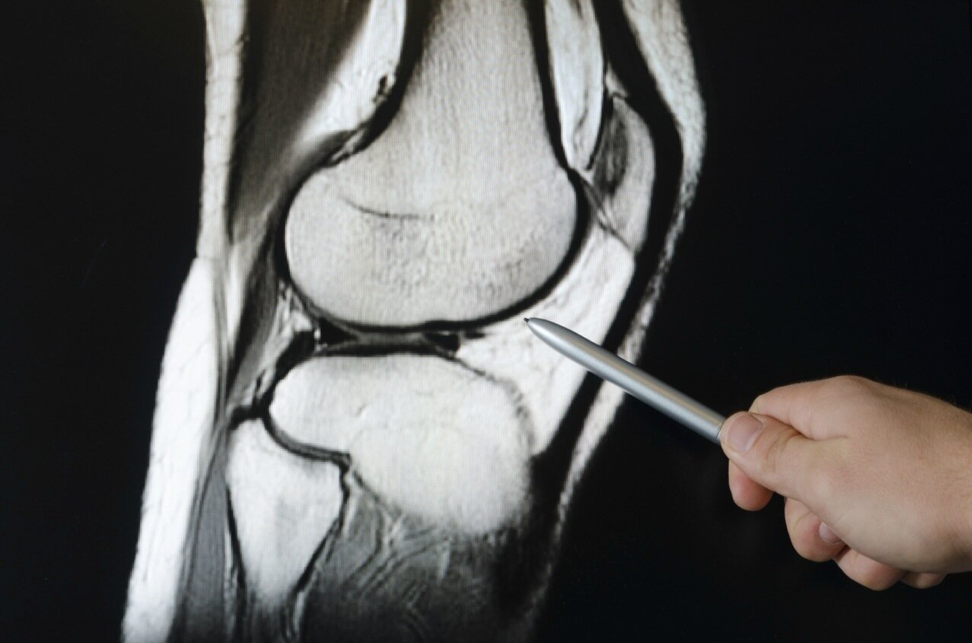 Повреждение мениска коленного сустава – симптомы и лечение без операции