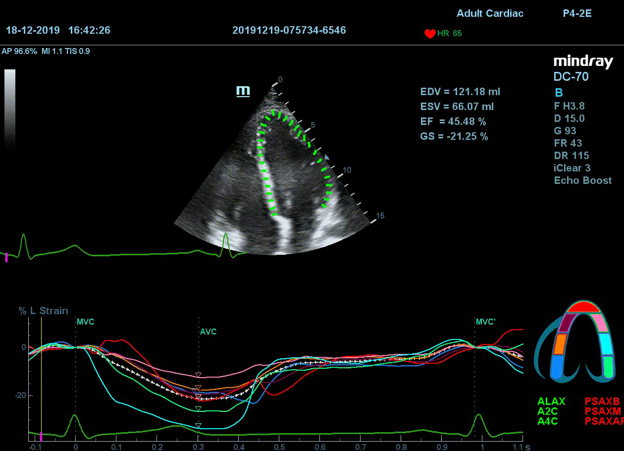 Технология Speckle-tracking на УЗИ аппарате DC-70 Pro X-Insight
