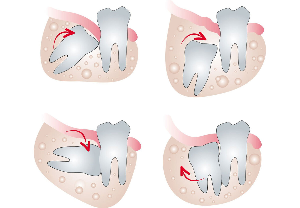   Зуб мудрости (третий моляр, «восьмерка») располагается с самого края зубного ряда. Эти зубы, в отличие от прочих, закладываются не до рождения человека, а только на 4-6 году жизни.-2