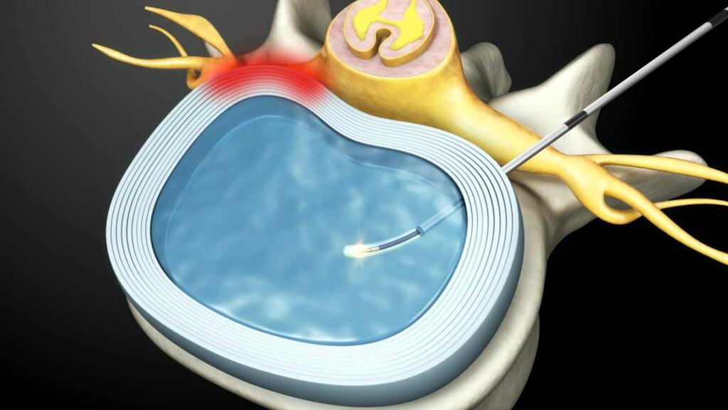 Нуклеопластика грыжи. Нуклеопластика лазерная межпозвонкового. Нуклеопластика после микродискектомии. Нуклеопластика грыжи позвоночника. Нуклеопластика грыжи.
