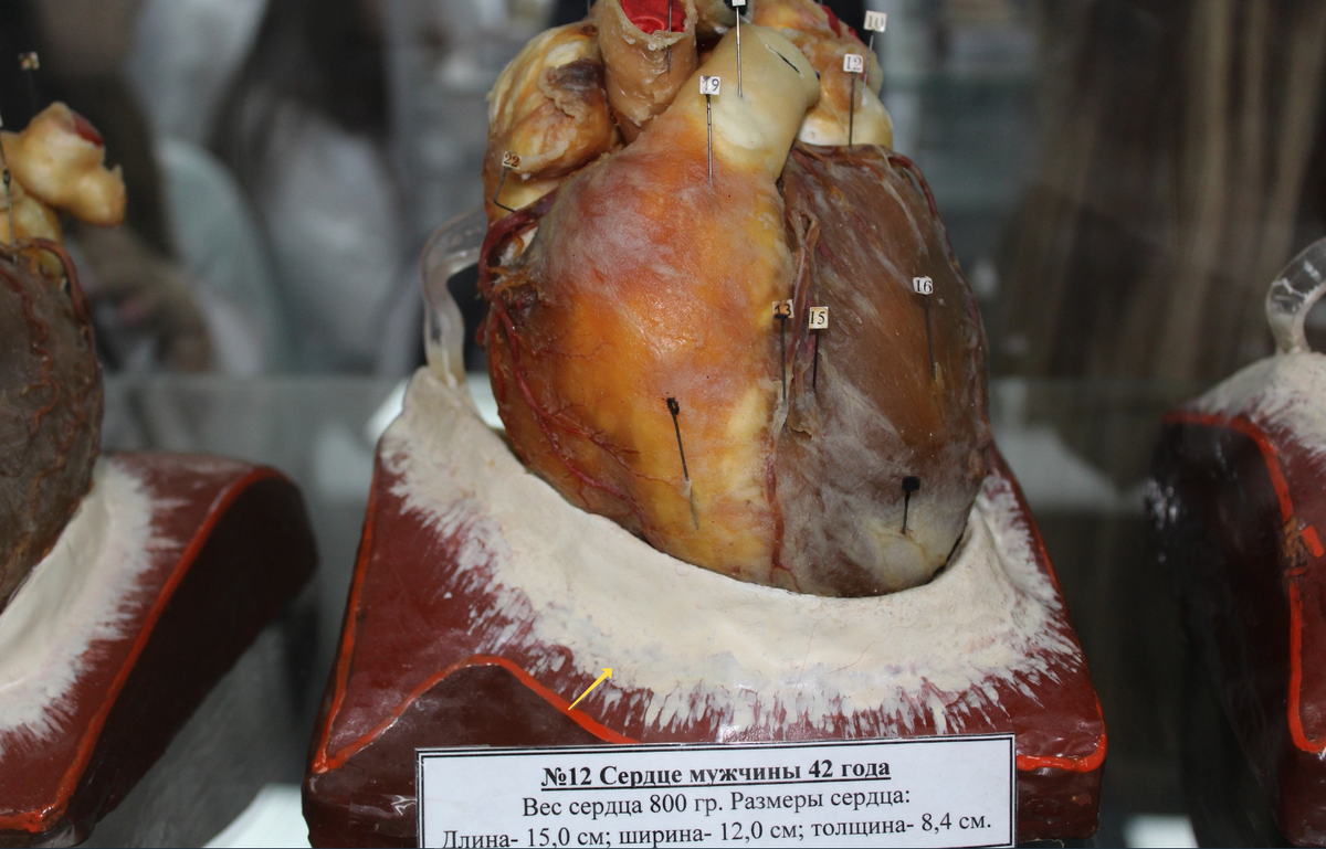 Экспонат медицинского музея 