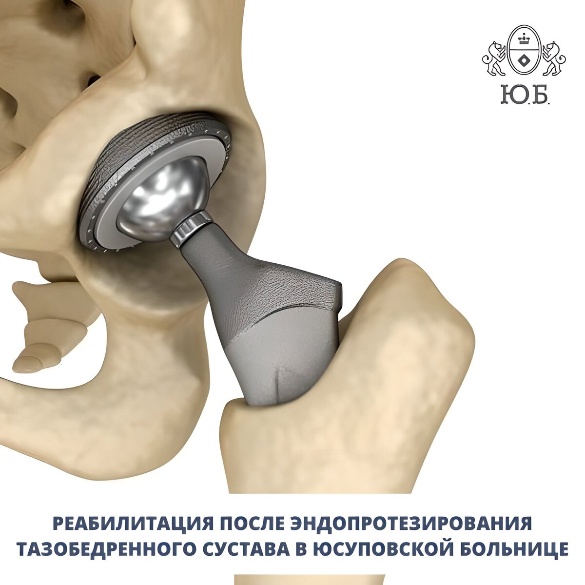 Вывих эндопротеза тазобедренного сустава