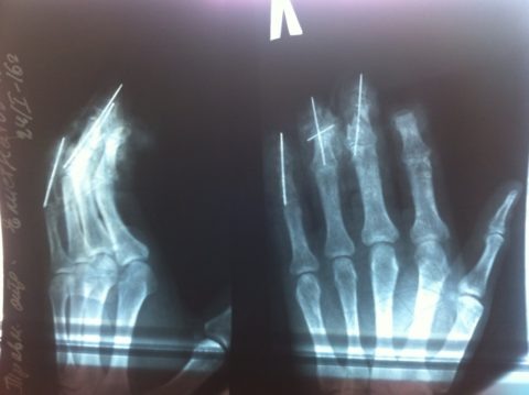  На снимке виден открытый краевой перелом среднего пальца на руке