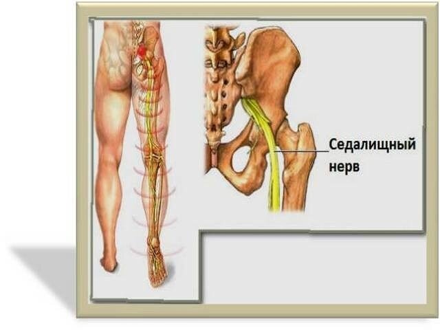 Защемление седалищного нерва, как лечить воспаление, ишиас