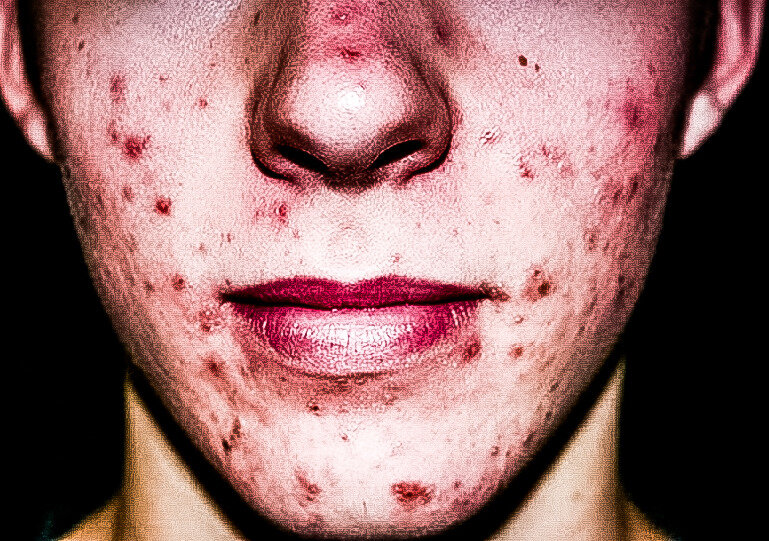 Эта статья будет очень полезна родителям, и близким молодых людей, также уже взрослым людям, чья кожа подвержена этим кошмарным заболеваниям... 