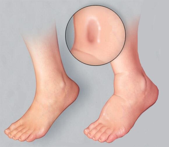 Лишняя жидкость, накопленная организмом, не сулит в себе ничего хорошего, а приносит только отечность и прочие неприятности.