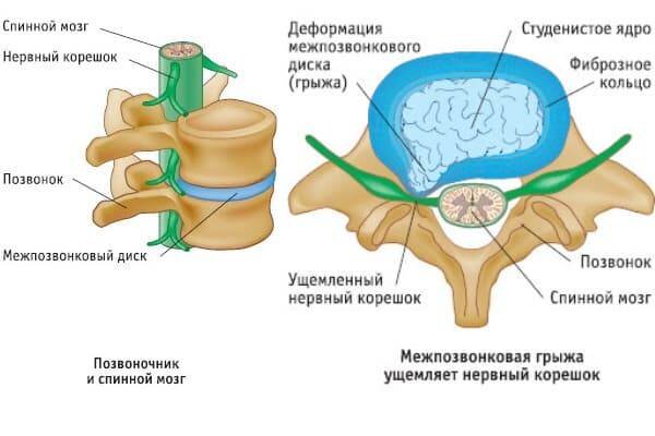 Поясничный остеохондроз код. Студенистое ядро межпозвоночного диска. Студенистое ядро межпозвоночных жиск. Студенистое ядро межпозвоночного диска на латинском. Остеохондроз и спинномозговая жидкость.