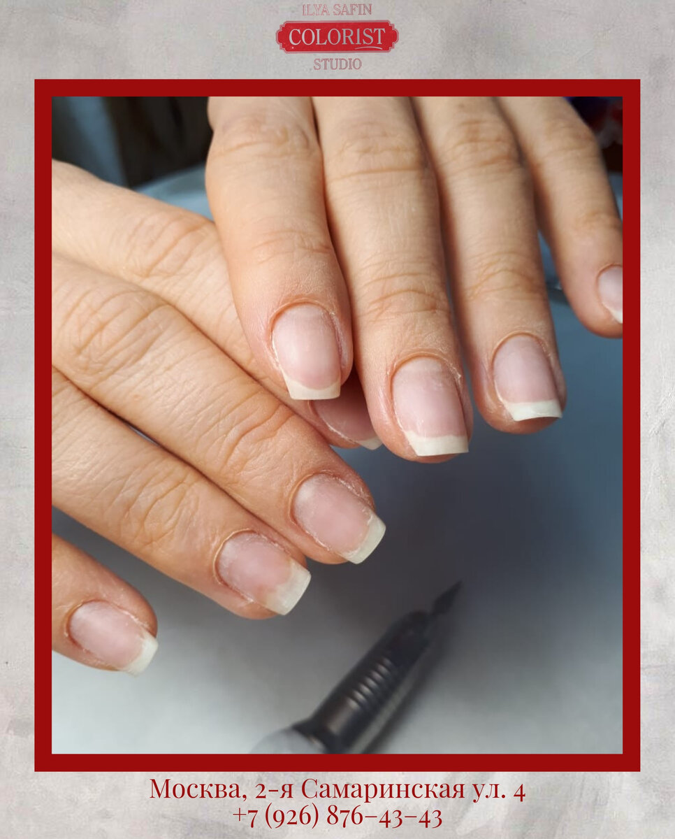 Онихолизис ногтей: виды, причины, симптомы и лечение. Как связаны онихолизис и гель-лак?