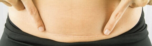 Оказывается, уход за рубцов включает в себя не только крема, но и массаж