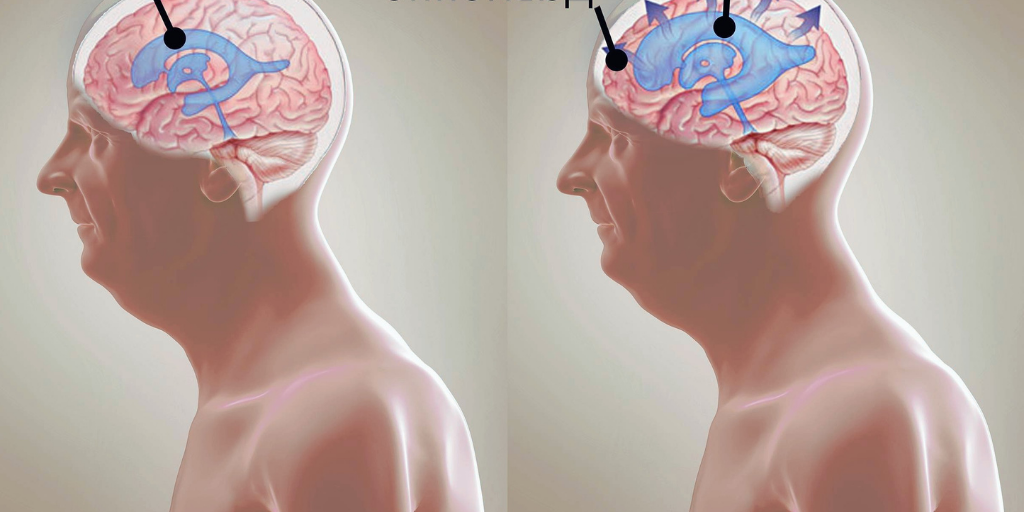  Повышение внутричерепного давления приводит к сдавлению нервных клеток,