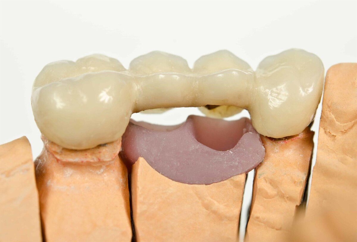 как выглядят мосты в стоматологии