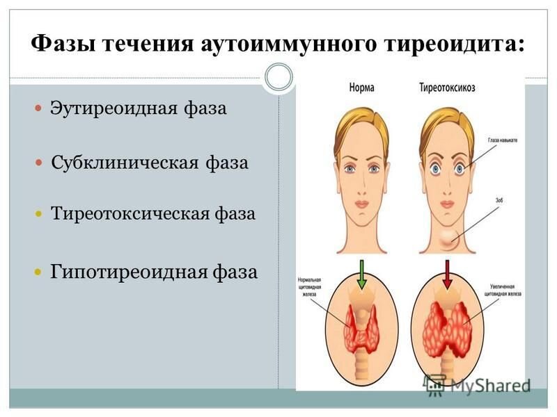 Диффузный токсический зоб