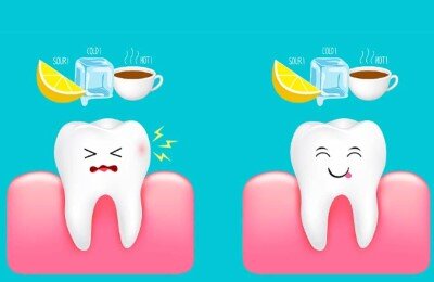 Повышенная чувствительность зубной эмали или гиперестезия носит временный характер, возникая в ответ на перепад температуры или механическое воздействие.