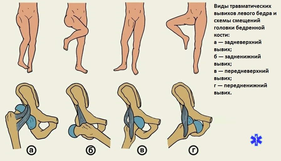 Подвывих тазобедренного сустава лечение, причины