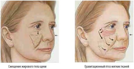 Мягкое тело щеки. Жировые пакеты лица старение. Жировые пакеты с возрастом.