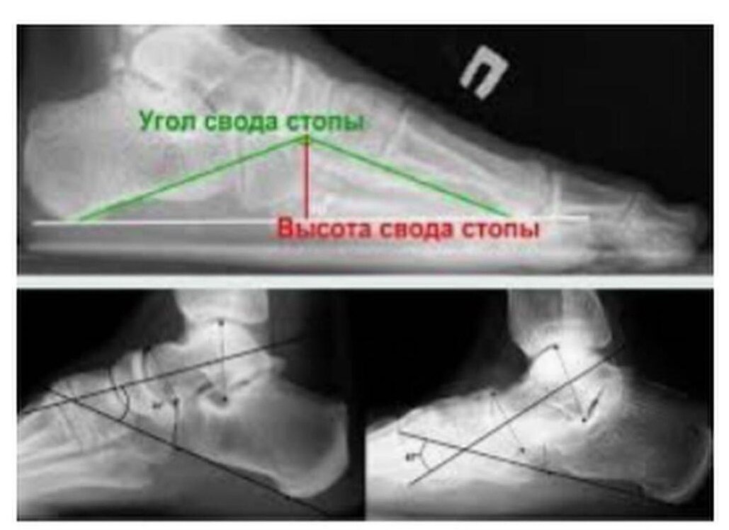 продольная плоскостопия рентгеноморфометрия. продольное плоскостопие 1 степени угол свода стопы. плоскостопие 1 степени высота свода стопы. плоскостопие 3 степени высота свода. плоскостопие 3 степени рентген.