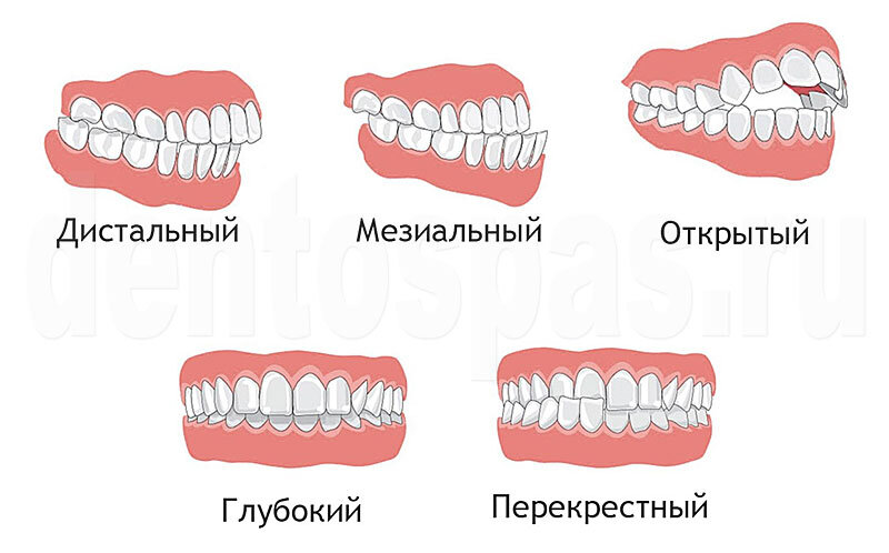 Виды аномалий прикуса