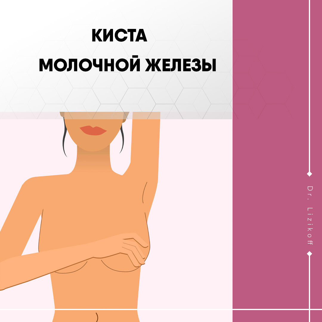 Киста в молочной железе | Никита Лизиков | Дзен