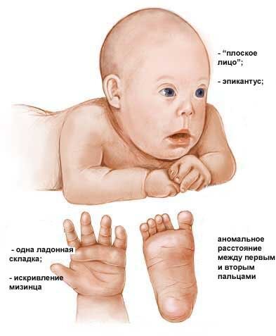 признаки синдрома Дауна