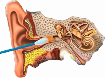 ушная пробка