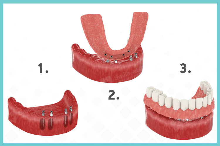 Нижние съемные протезы на имплантах