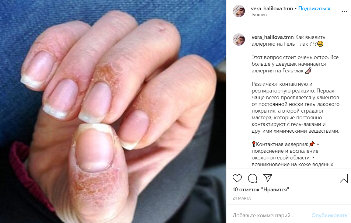 Аллергия на гель-лак