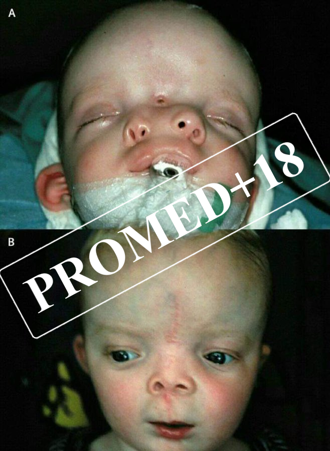 Diprosopus dirrhinus