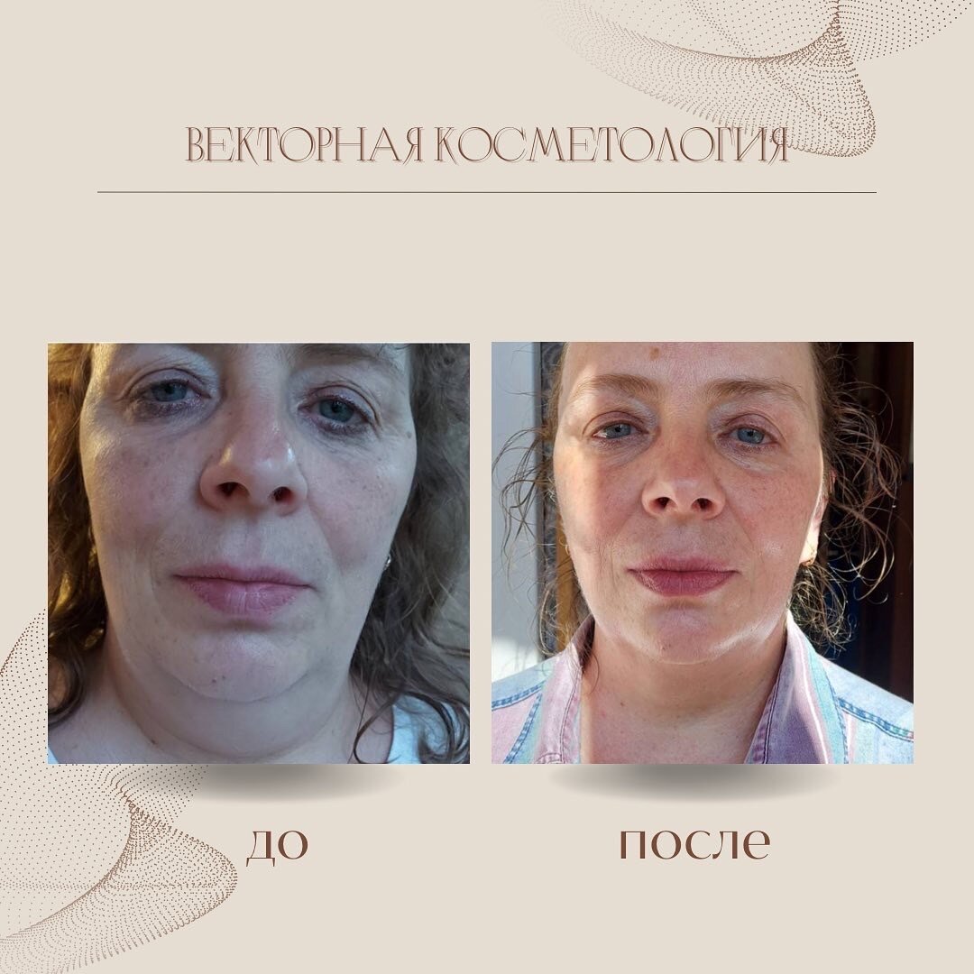 До/после Векторного массажа
