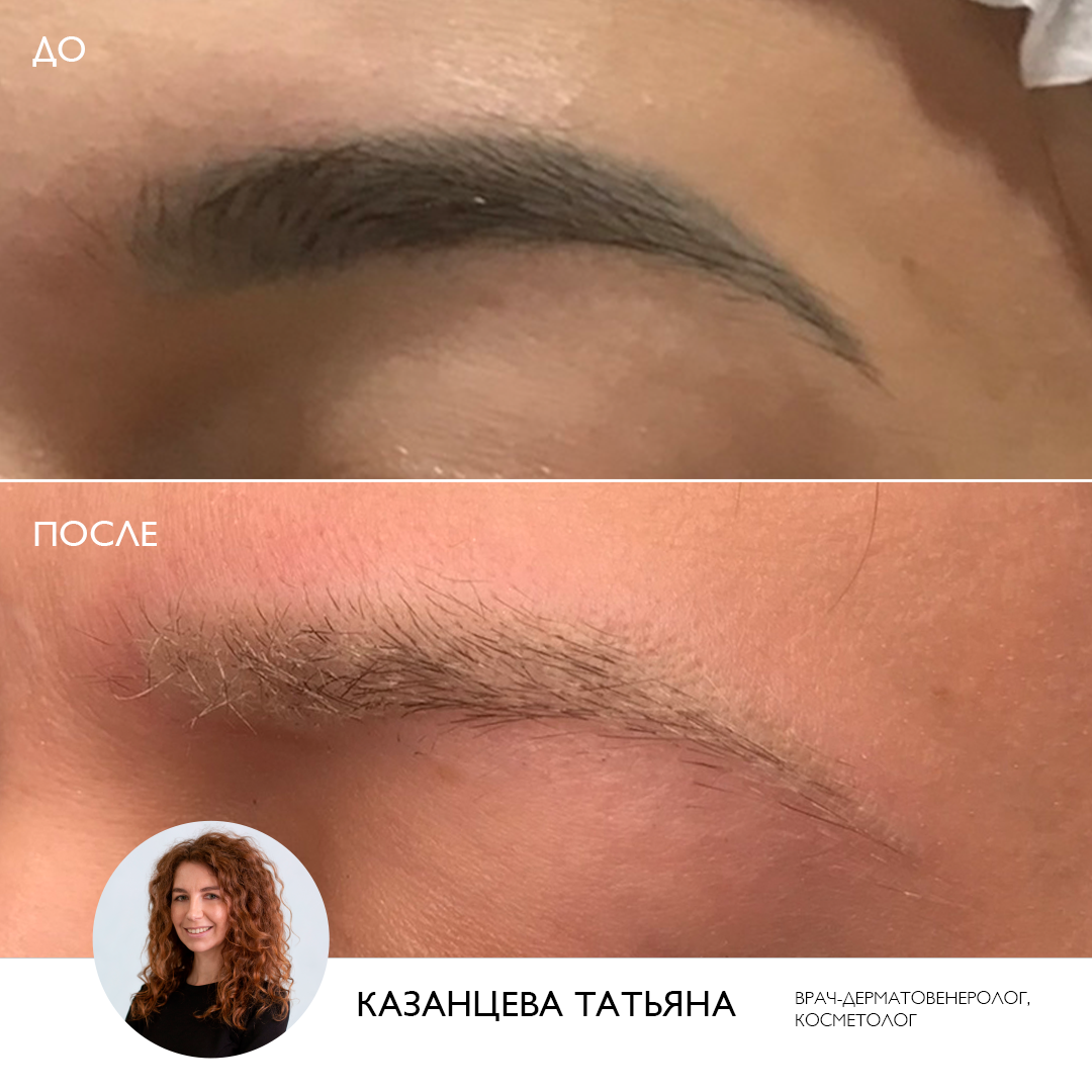 Работы по удалению ПМ в клинике ЭСТЕЛАБ