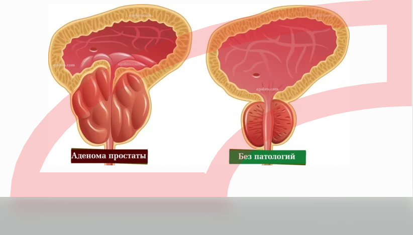 Чем отличается аденома простаты. Аденома простаты у мужчин. Аденома простаты у мужчин симптомы. Строение аденомы простаты.