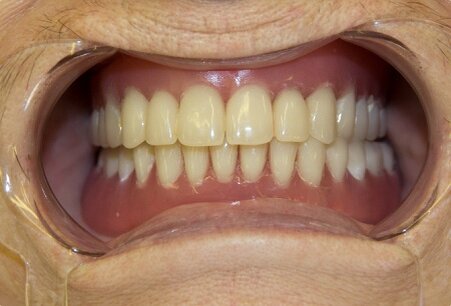 All-on-4 восстанавливает эстетику и функциональность