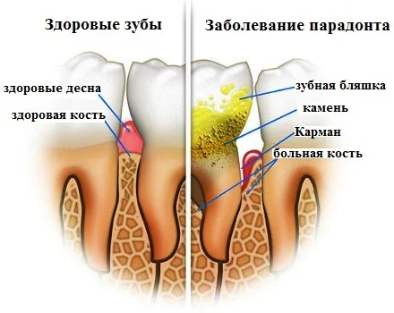 Источник: https://ozubkah.ru 